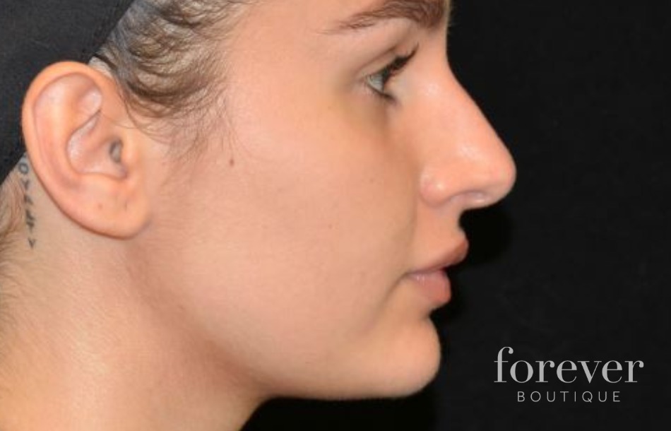 Results of hyaluronic acid nose injections (2)