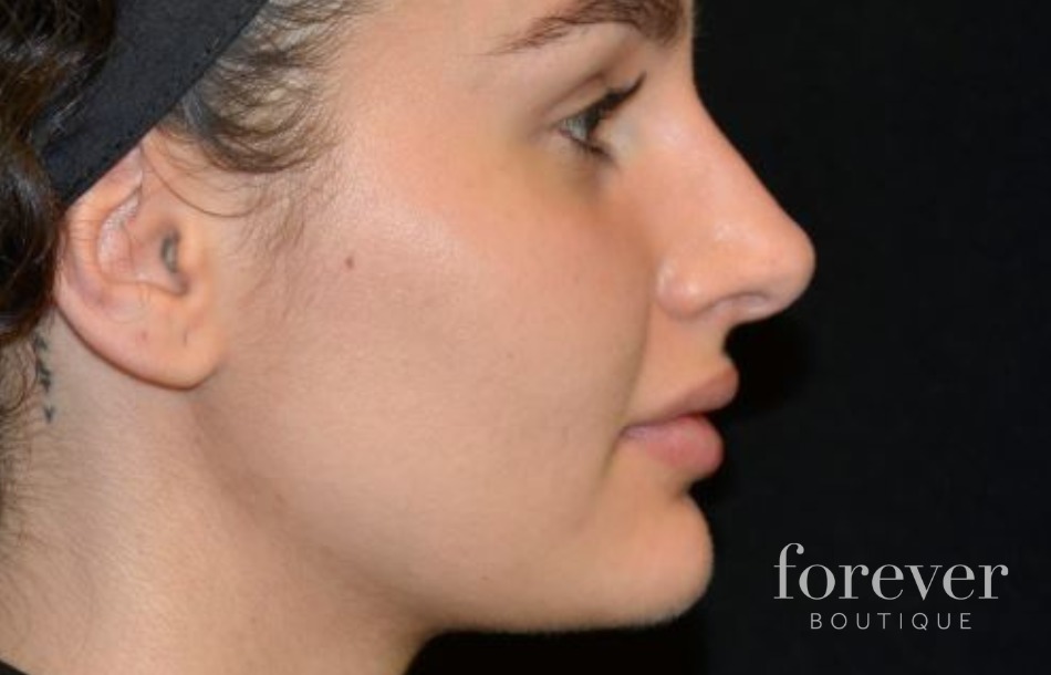 Results of hyaluronic acid injections nose 2