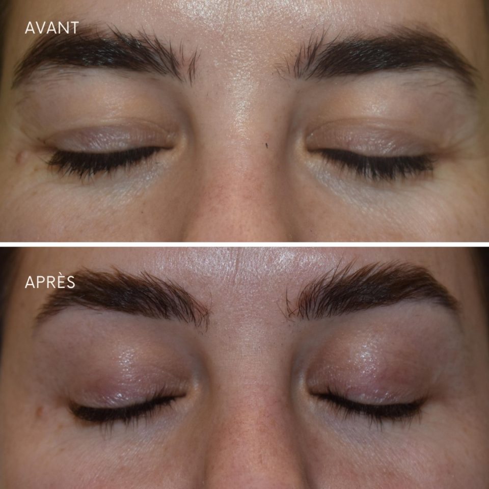 Before After PLEXR_Blepharoplasty_without_surgery