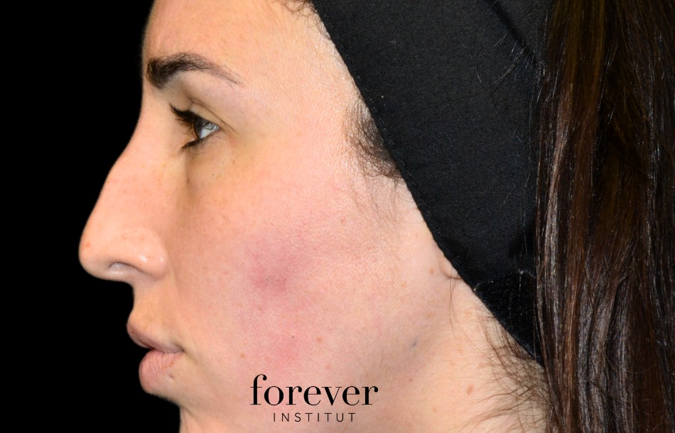 Before_after_rhinoplasty_medical_injections